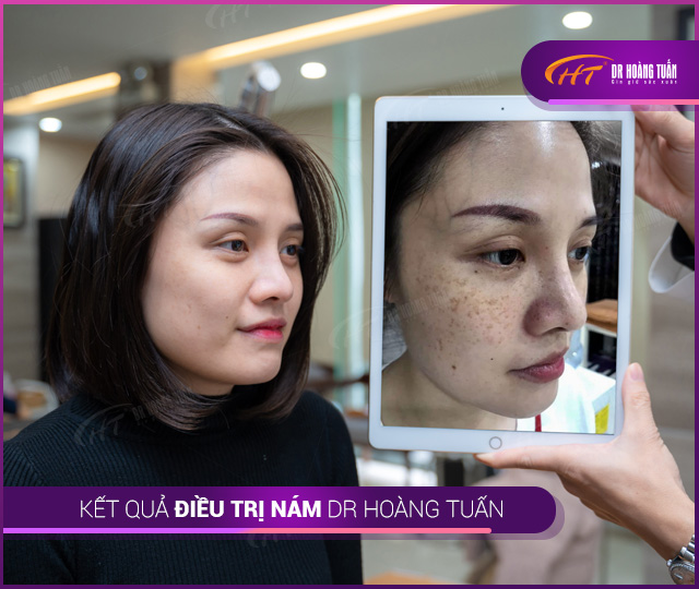 Kết quả điều trị Thẩm mỹ Hoàng Tuấn